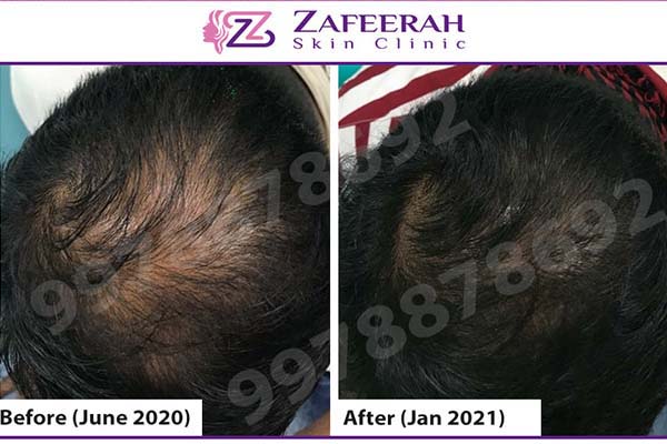 alopecia areata hair treatment before after