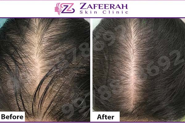 Platelet Rich Plasma (PRP) Treatment for Hair Loss in Mumbai | PRP Hair  Treatment | Zafeerah Skin Clinic Mumbai
