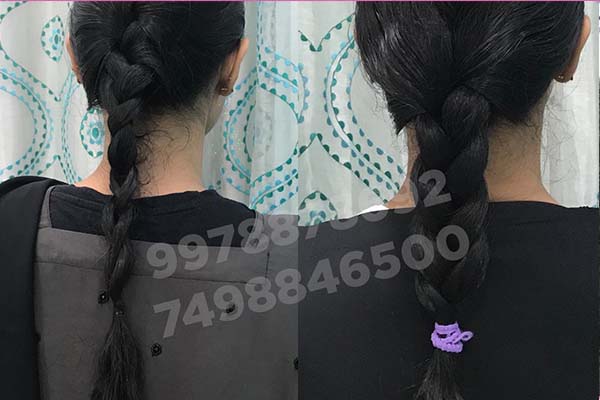 hair loss treatment before after