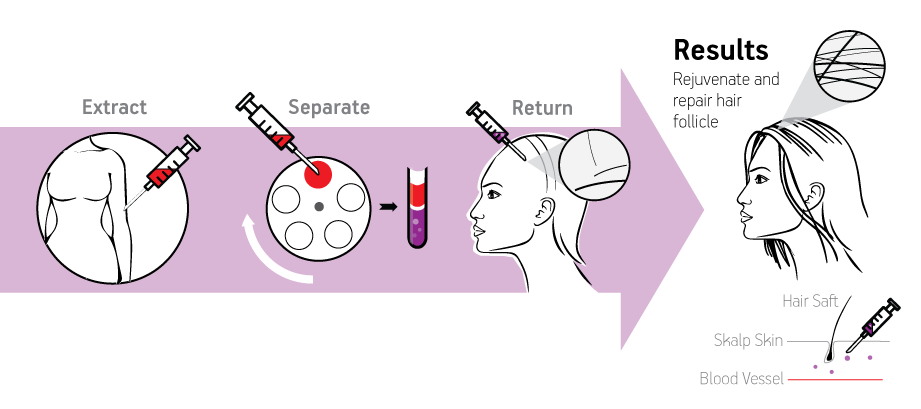 prp hair treatment procedure